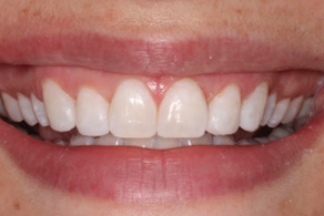 composite after 1