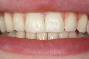 composite after 4