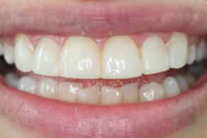 composite after 5