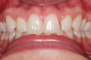 composite before 1