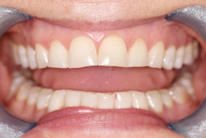 composite before 2