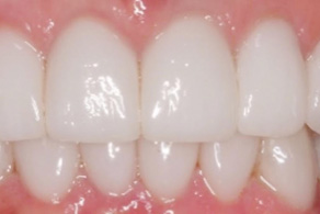 gummy smile after 1