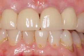 gummy smile before 1