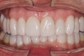 invisalign aligners after 1
