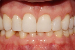 invisalign aligners before 1
