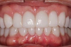 smile design after 1