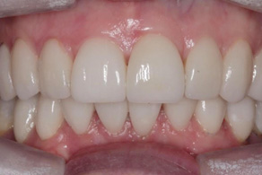 smile design after 2