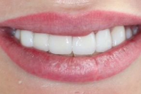 smile design after 3