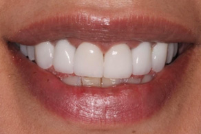 smile design after 4