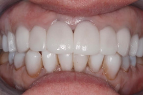 smile design after 5