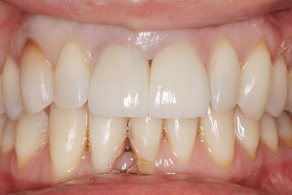 smile design after 6