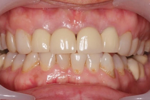 smile design before 1
