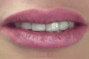 smile design before 3