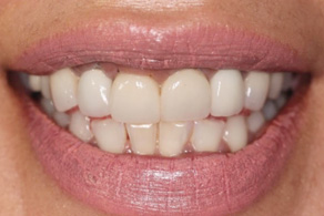smile design before 4
