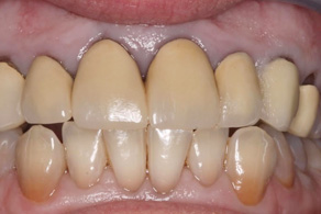 smile design before 5