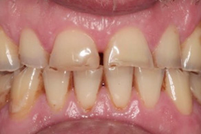 smile design before 7