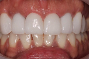 veneers after 1
