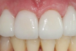 veneers after 2