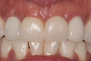 veneers before 1