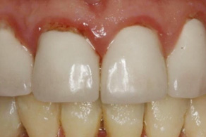 veneers before 2