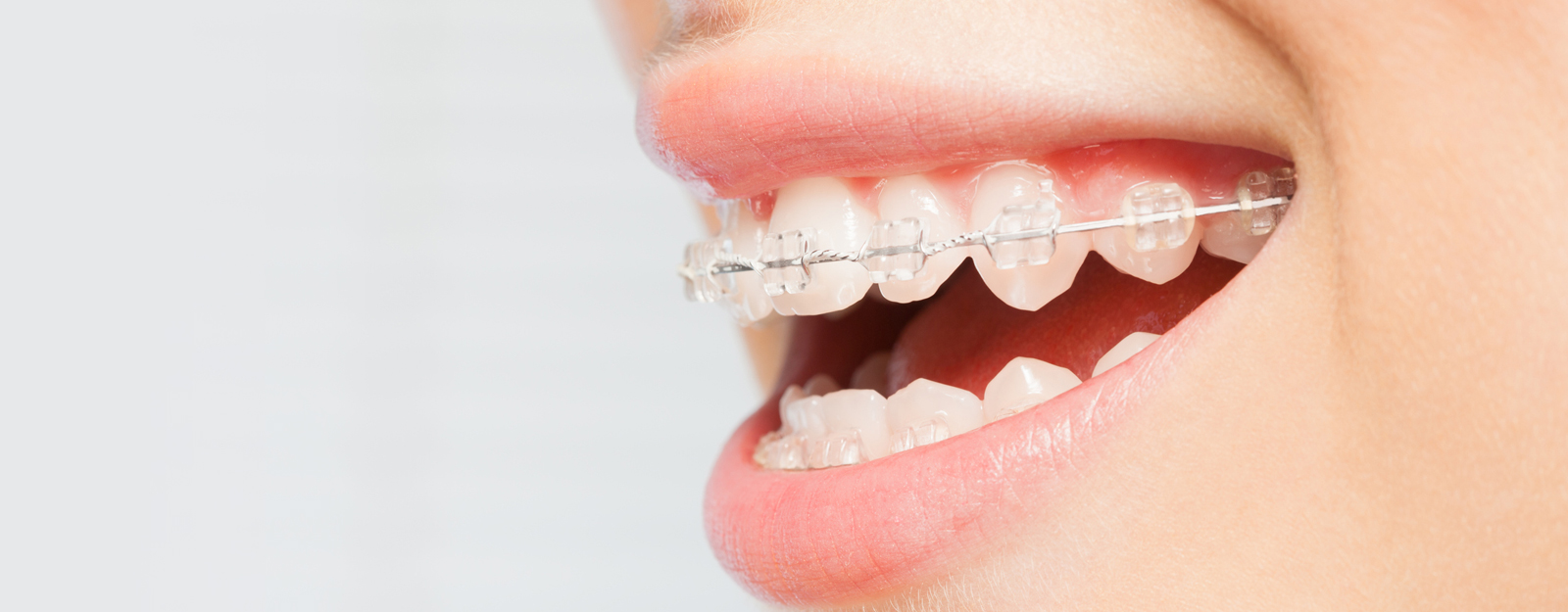 Fixed Aesthetic Braces
