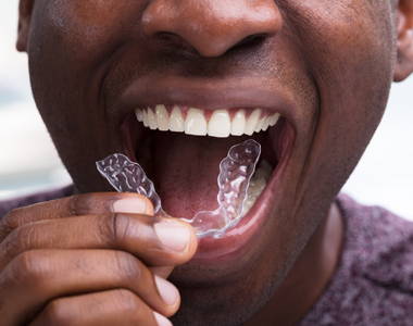 Invisalign