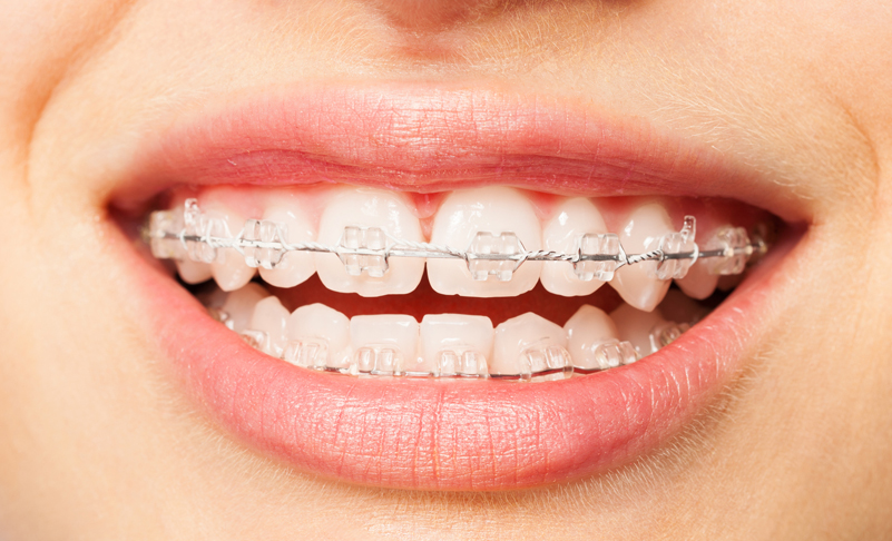 Invisible Braces in Highgate
