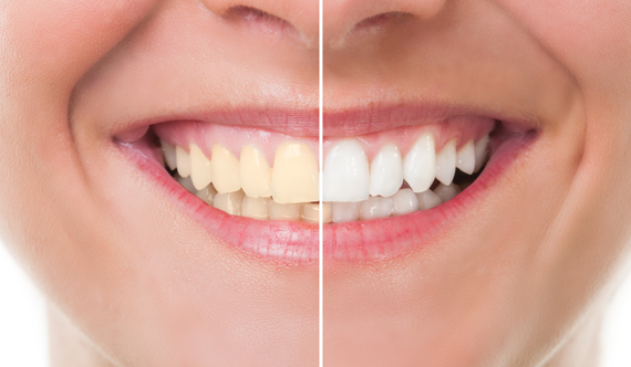 Tooth Whitening Facts