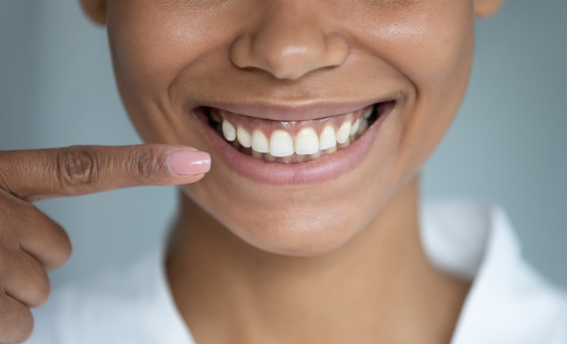 What is a Gummy Smile?