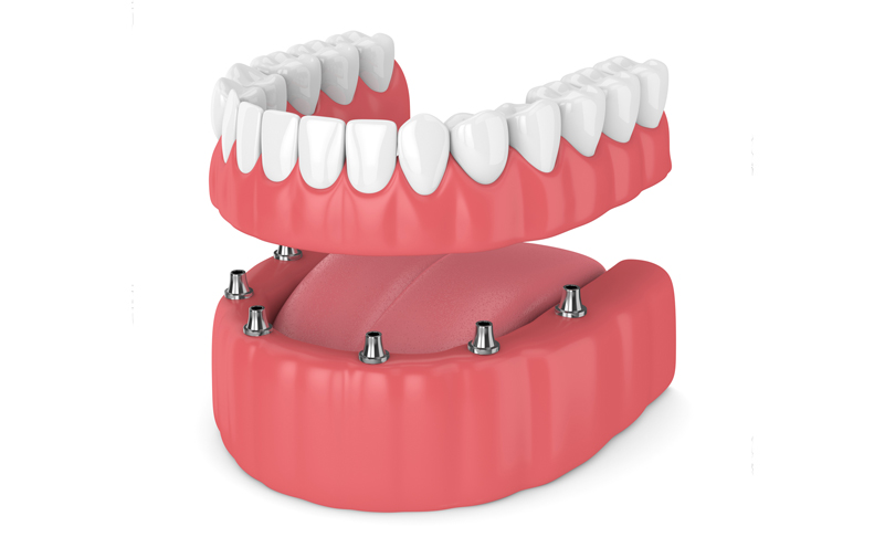 Why choose implant retained dentures?