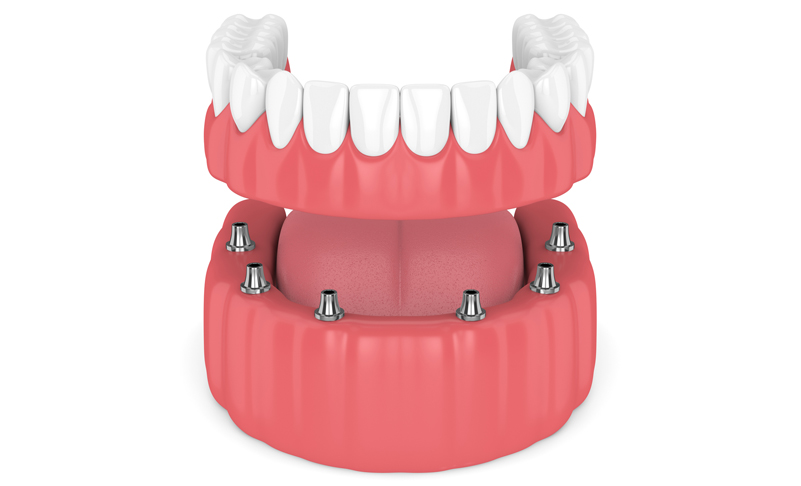 Why replace old dentures?